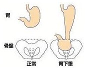 該如何預防胃下垂